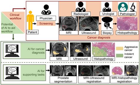 A Review Of Artificial Intelligence In Prostate Cancer Detection On