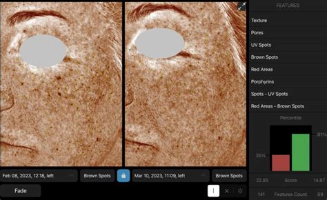 BBL Before & After, Case 1 | , age 45 – 54 | Pura Vida Medspa ...