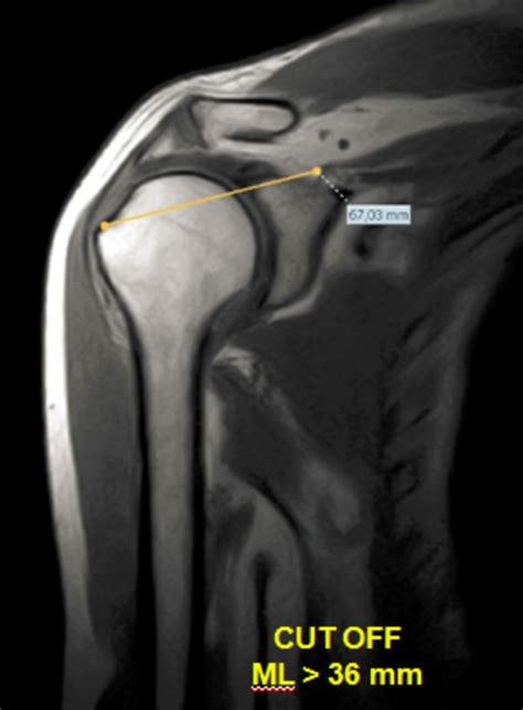 Rotator Cuff Tear Mri