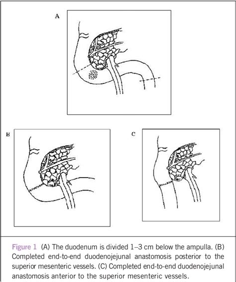 Figure 1 From Pancreas Sparing Distal Duodenectomy For Infrapapillary