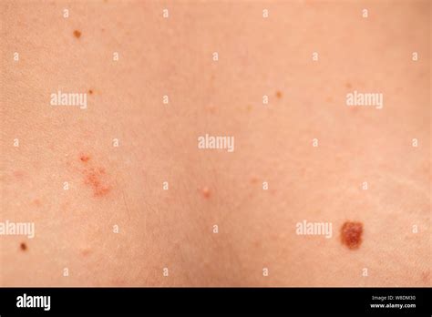 Close Up Picture Of Dangerous Brown Nevus On Human Skin Melanoma