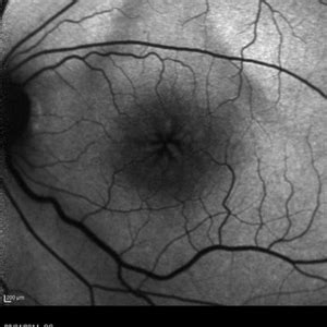 Cystoid Macular Edema Retina Image Bank