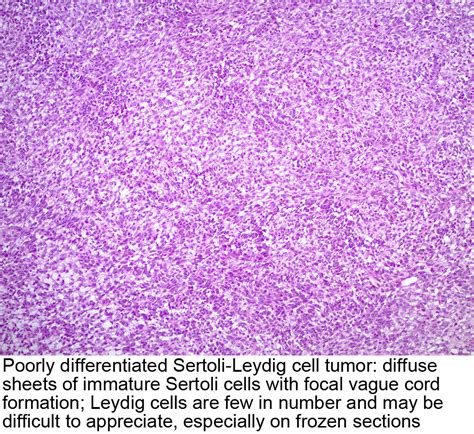 Pathology Outlines Sertoli Leydig Cell Tumor