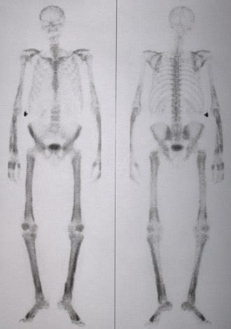 Hypertrophic osteoarthropathy - Wikipedia