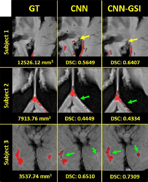 Figure 9 From Segmentation Of White Matter Hyperintensities Using