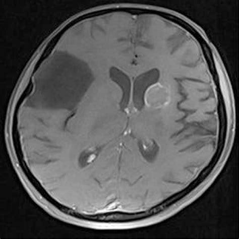 e MRI brain showing inflammatory granuloma in left caudate nucleus and... | Download Scientific ...