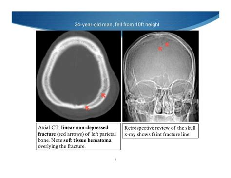 Imaging Of Head Trauma Part 2