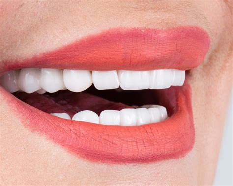 The Process Of Getting Veneers In Bacchus Marsh Maddingley Dental Care