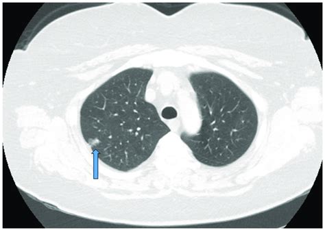 Early Stage Nsclc Detected During Screening And Treated With Download Scientific Diagram