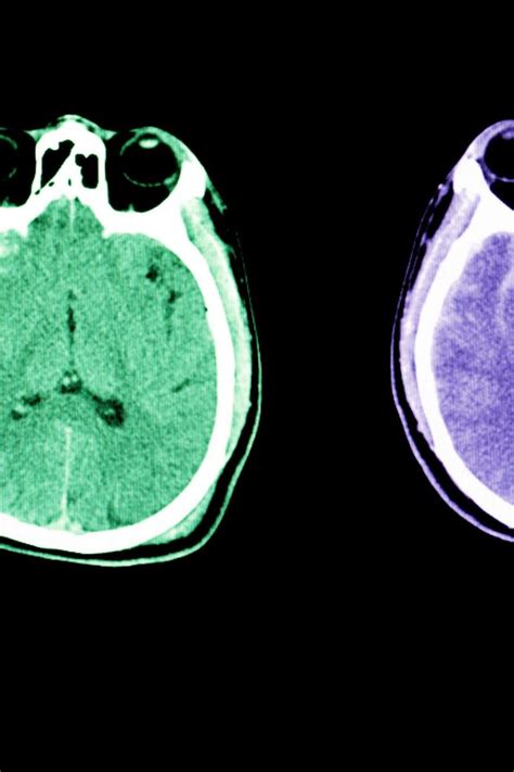 Subarachnoid Space Hemorrhage Ultrasound