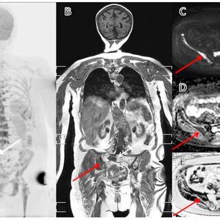 (A) MRI scan of multiple myeloma patient with several lesions of lumbar ...