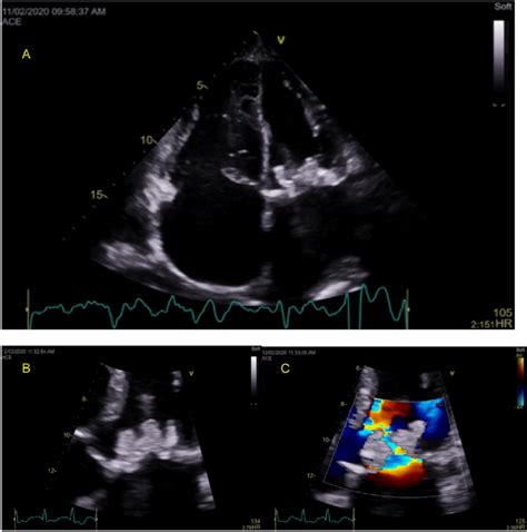 Panel A Transthoracic Apical Chamber View Demonstrating Biatrial