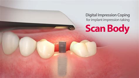 Digital Impression Coping For Implant Impression Taking ScanBody