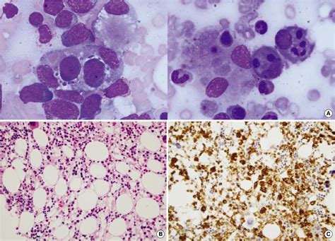 Figure 1 From A Case Of Epstein Barr Virus Associated Hemophagocytic