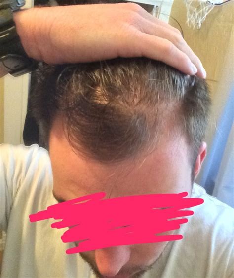 23-Year-Old Wants to Know If His Hairline is Maturing or Receding