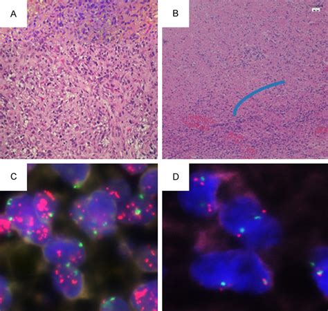 Histopathology Egfr Expression And Egfr Amplification Determined By