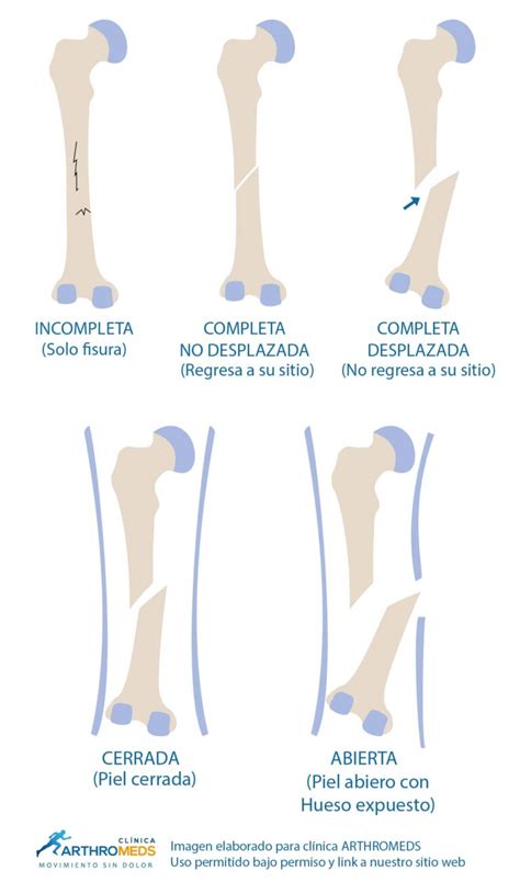 Como Curar Una Fractura De Hueso Lima Per