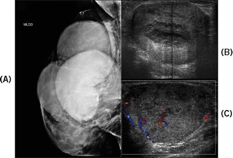 Figure 2 From Malignant Phyllodes Tumor Of The Breast Case Report