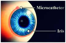 Canaloplasty New Glaucoma Treatments