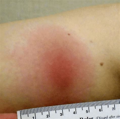 The Myth Of The Bullseye Why Recognizing The Spectrum Of Lyme Disease Rashes Is Critical For