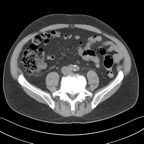 Diverticulitis Image Radiopaedia Org Hot Sex Picture