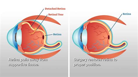 Retinal Detachment Surgery Treatment Getwellgo Indias Best