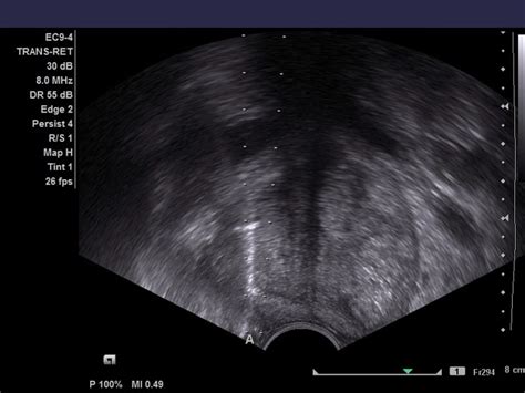 Prostate Biopsy Trus Or Mri Us Fusion Method Chin Chong Min Urology