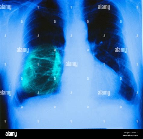 Color Enhanced Chest X Ray Showing Asbestosis A Kind Of Pneumoconiosis