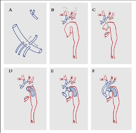 Figure 1 from A modified procedure in aortic arch replacement with no ...