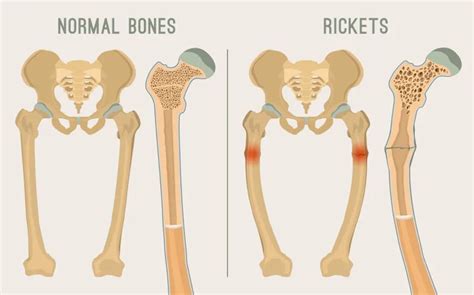 Osteomalacia: Symptoms, Causes, and Treatment – ActiveBeat – Your Daily ...