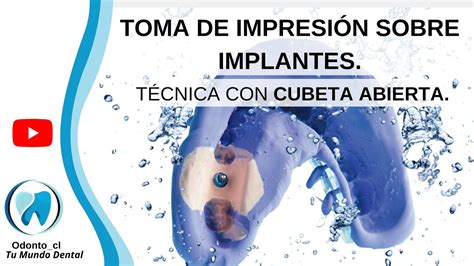 Gu A Paso A Paso Impresi N De Implantes Con Cubeta Abierta Youtube