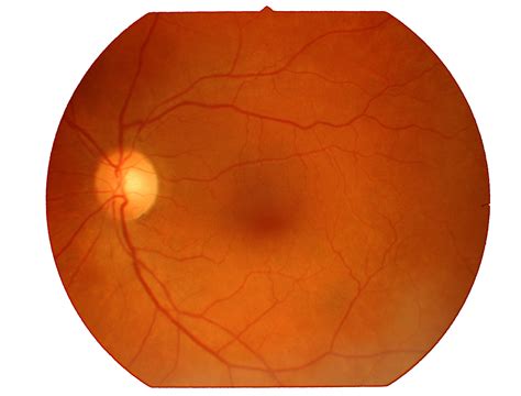 Glaucoma - World Stem Cell Clinic