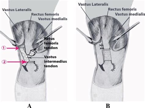 1 Positional Tenotomy At The Musculotendinous Junction Of The Vastus Download Scientific