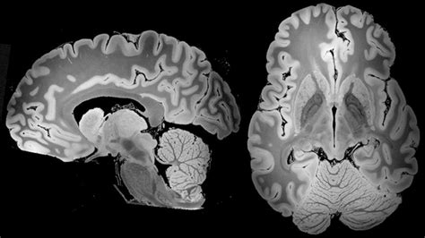 Resonancia Magnetica Del Cerebro