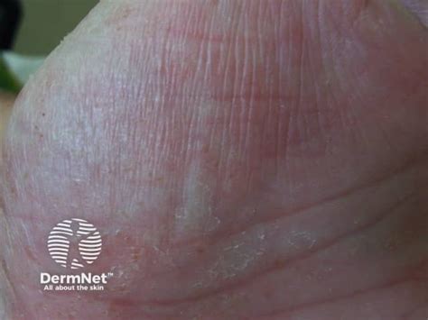 Dyshidrotic Eczema Pompholyx Images — Dermnet