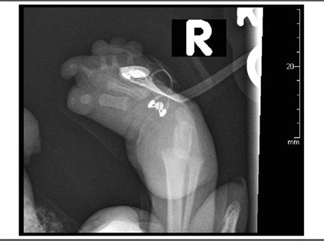 Figure From Prenatal Sonographic Detection Of Multiple Congenital