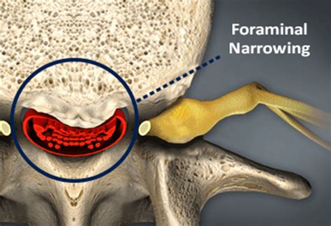 Foraminal Stenosis (Neural Foraminal Narrowing) Neural foraminal ...