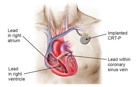How cardiac resynchronization devices work - Boston Scientific