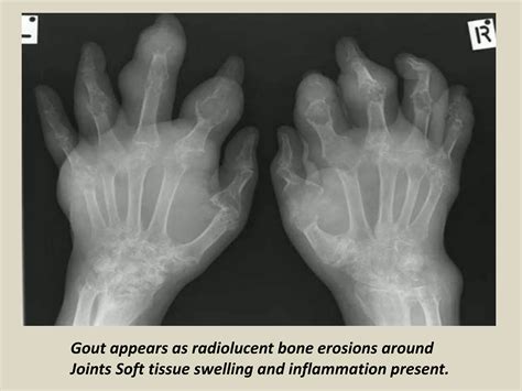 Presentation1.pptx, radiological imaging of gout disease. | PPTX