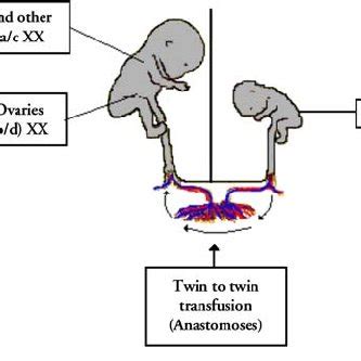 (PDF) Chimerism and tetragametic chimerism in humans: Implications in ...