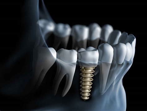 Expert Dental Implants Services | Sunset Dental Centre