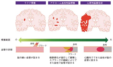 脳梗塞 | 循環器情報サイトAssist