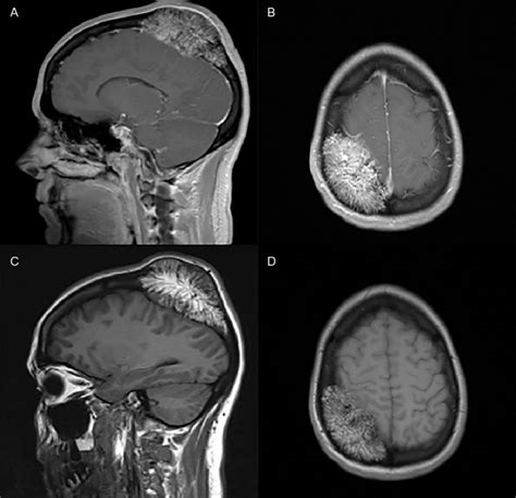 T1 Weighted Magnetic Resonance With Sagittal A And Axial B Views