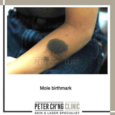 Patient Mailbox How To Remove A Birthmark On The Face Peter Chng