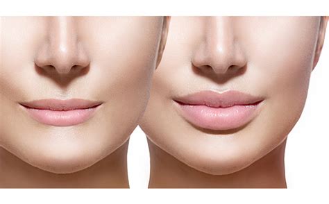 Dermal Fillers | Lip Fillers| Dermal Lip Fillers Clinic Singapore