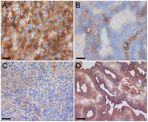 Cadherin Expression Cdh And Cdh Expression Of Cdh Protein