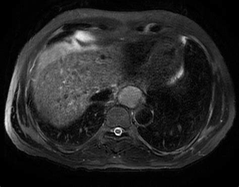 Foregut Duplication Cyst Image Radiopaedia Org