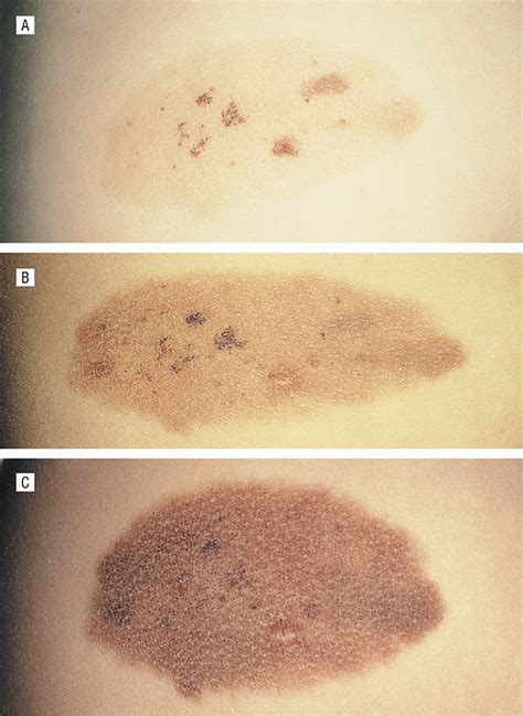 Speckled Lentiginous Nevus Within The Spectrum Of Congenital