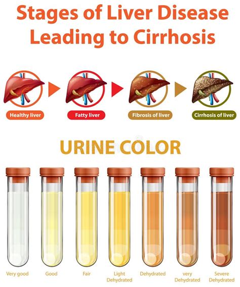 Stages Of Liver Disease Leading To Cirrhosis Stock Vector Illustration Of Sciences Scientific