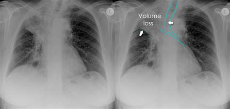 Right Middle Lobe Collapse X Ray